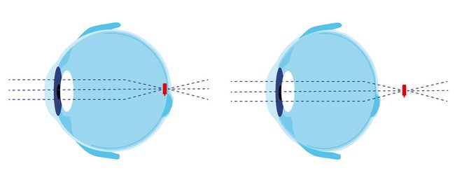 Beim normalen Auge (links) fällt der Brennpunkt (rot) genau auf die Netzhaut. Bei der Hyperopie (rechts) liegt der Brennpunkt (rot) aufgrund des zu kurzen Augapfels hinter der Netzhaut. Dadurch ist die Sicht unscharf.