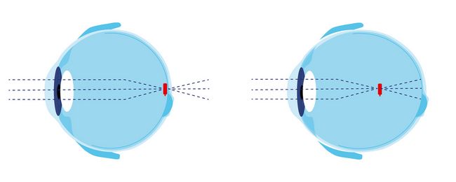 Dans un œil normal (à gauche), le point focal (rouge) se forme exactement sur la rétine. En cas de myopie (à droite), le point focal (rouge) se situe devant la rétine, car le globe oculaire est trop long. La vision de loin est donc floue.
