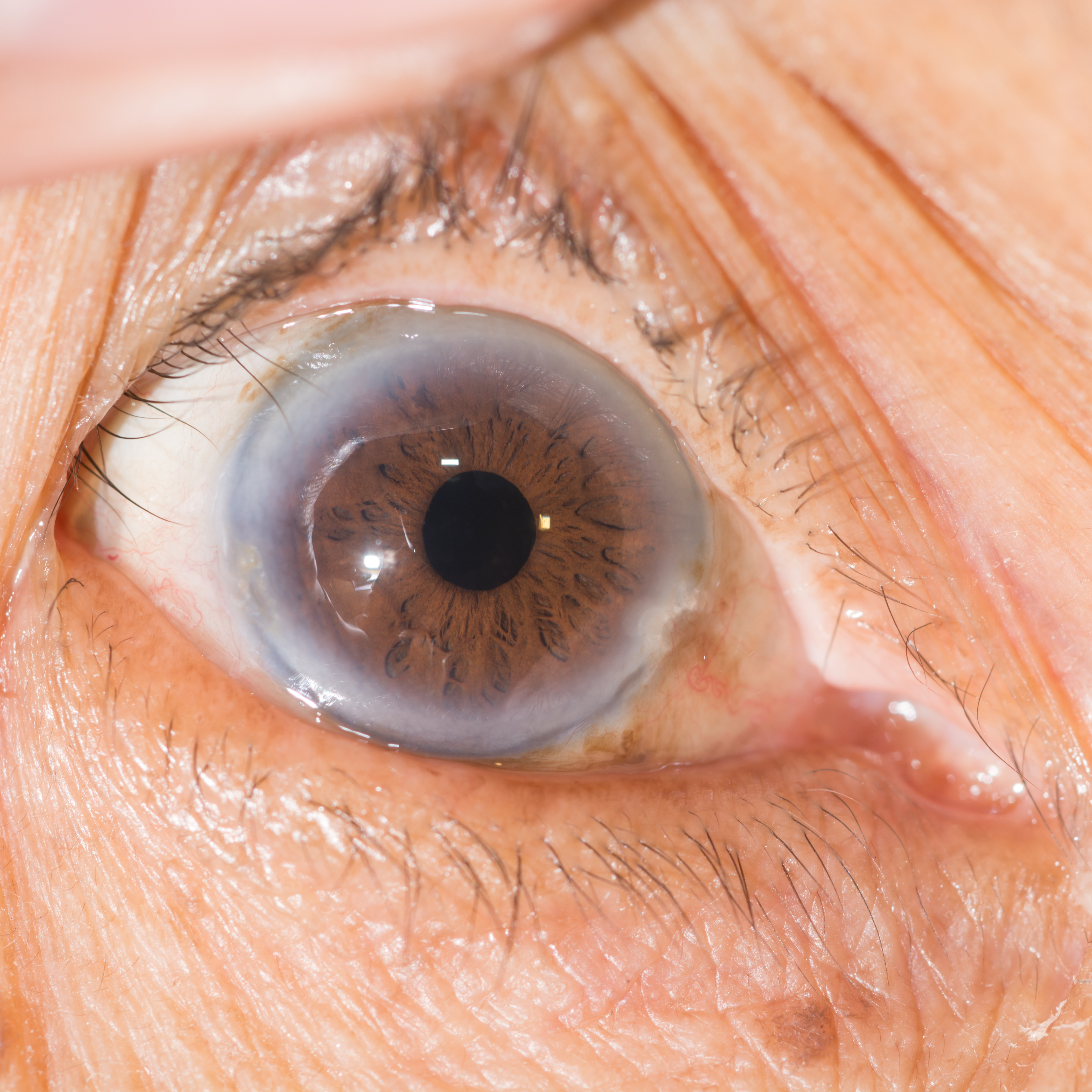 Problème De Vue Affectant La Netteté Des Contours Les maladies des yeux les plus fréquentes - Société Suisse d'Ophtalmologie